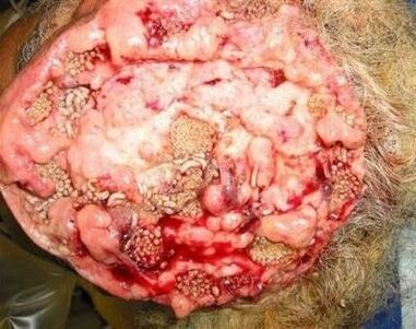 paraziți în creierul uman